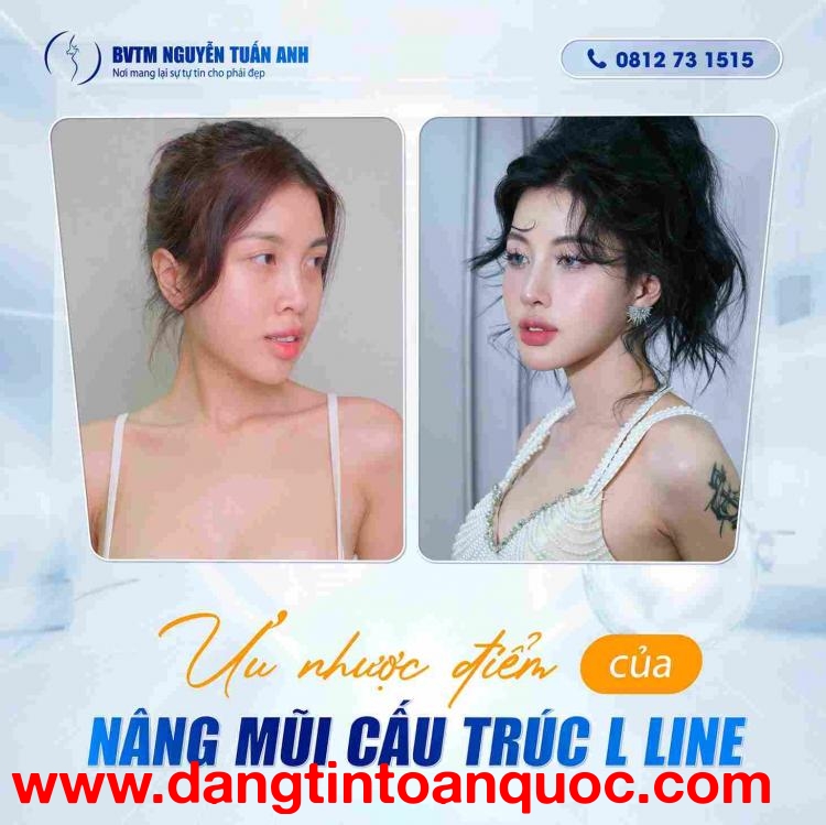 Ưu Nhược Điểm Của Nâng Mũi Cấu Trúc L Line