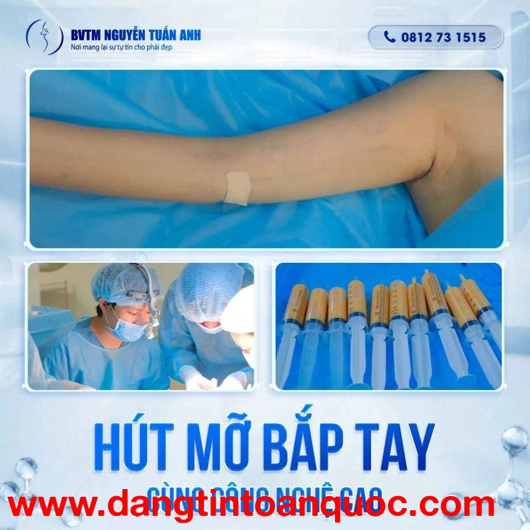 Nguyên nhân tích tụ mỡ vùng bắp tay