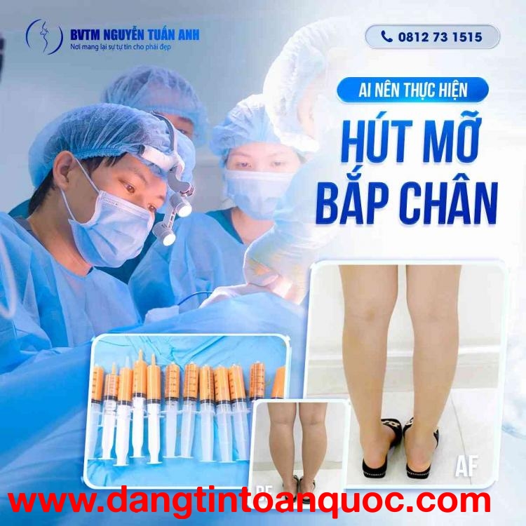 Ai nên thực hiện hút mỡ bắp chân?