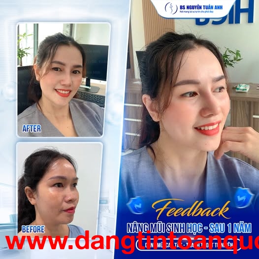  ???? Nâng mũi sinh học: Giải pháp cho diện mạo thanh thoát và tự tin hơn