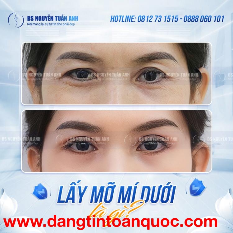 Hiểu rõ nguyên nhân hình thành quầng thâm dưới mắt