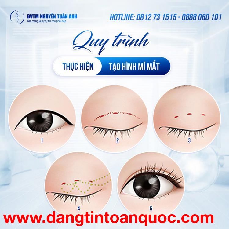 Lợi ích nổi bật của cắt mí mini deep