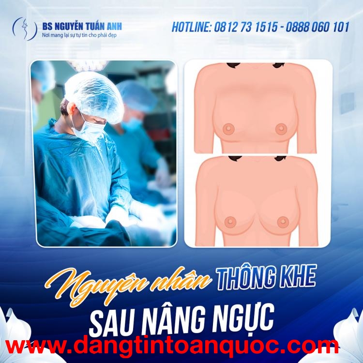 Hiểu rõ về thông khe sau nâng ng.ực
