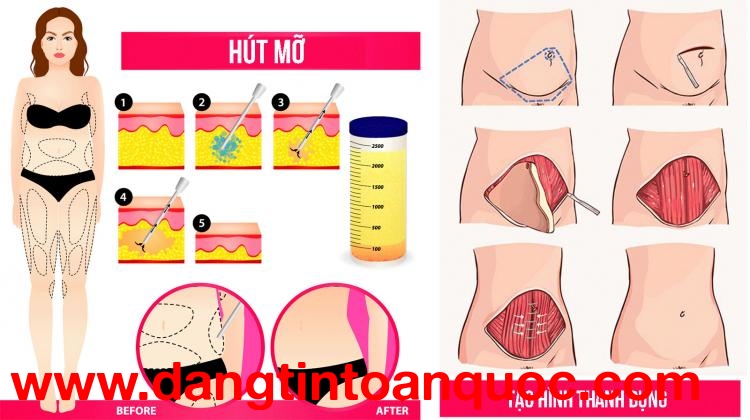Phân biệt tạo hình thành bụng và hút mỡ bụng