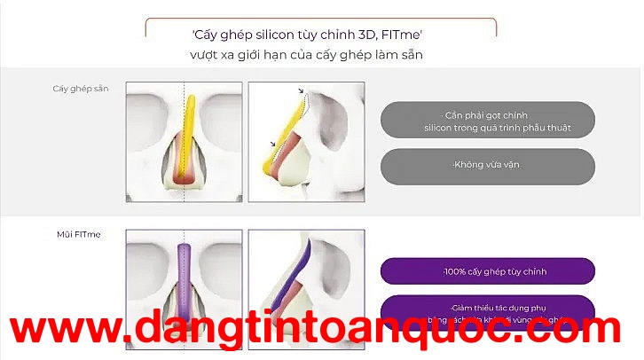 Xu hướng tạo dáng mũi cá nhân hóa hiện nay