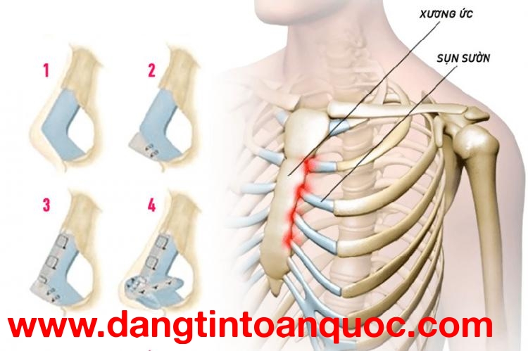 Nâng mũi sụn sườn có đảm bảo an toàn tuyệt đối không?