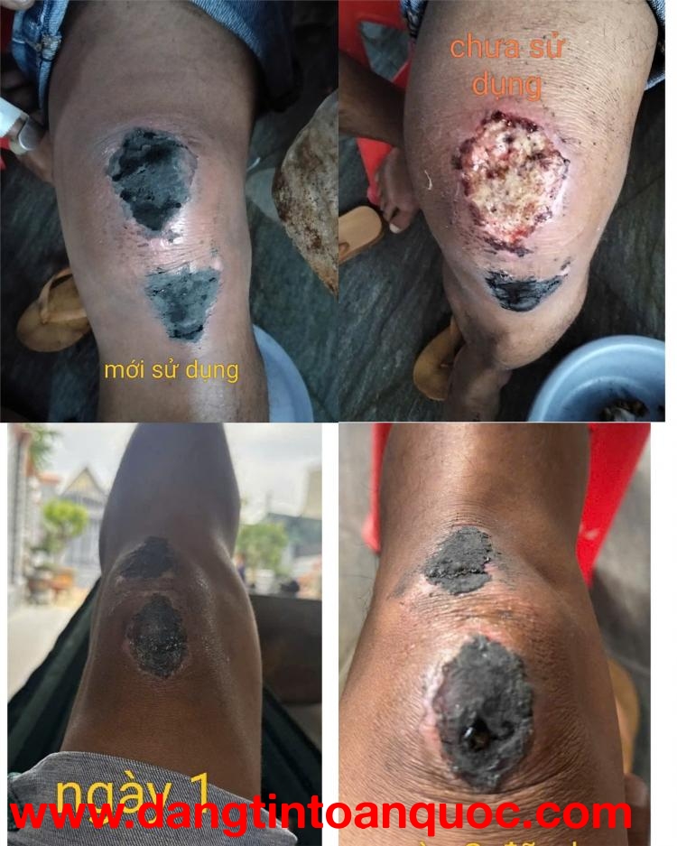 BỘT KHÔ SÁT VẾT THƯƠNG – GIẢI PHÁP Giúp Vết Thương Nhanh Lành, Nhanh Khô An Toàn - BỘT KHÔ Y SĨ VINH