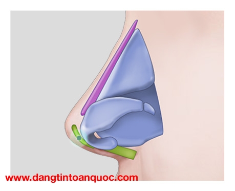 Mũi lộ sóng sau phẫu thì cần sử dụng phương pháp nào?